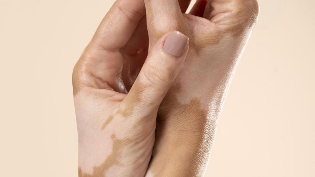 Understanding vitiligo – The Hindu